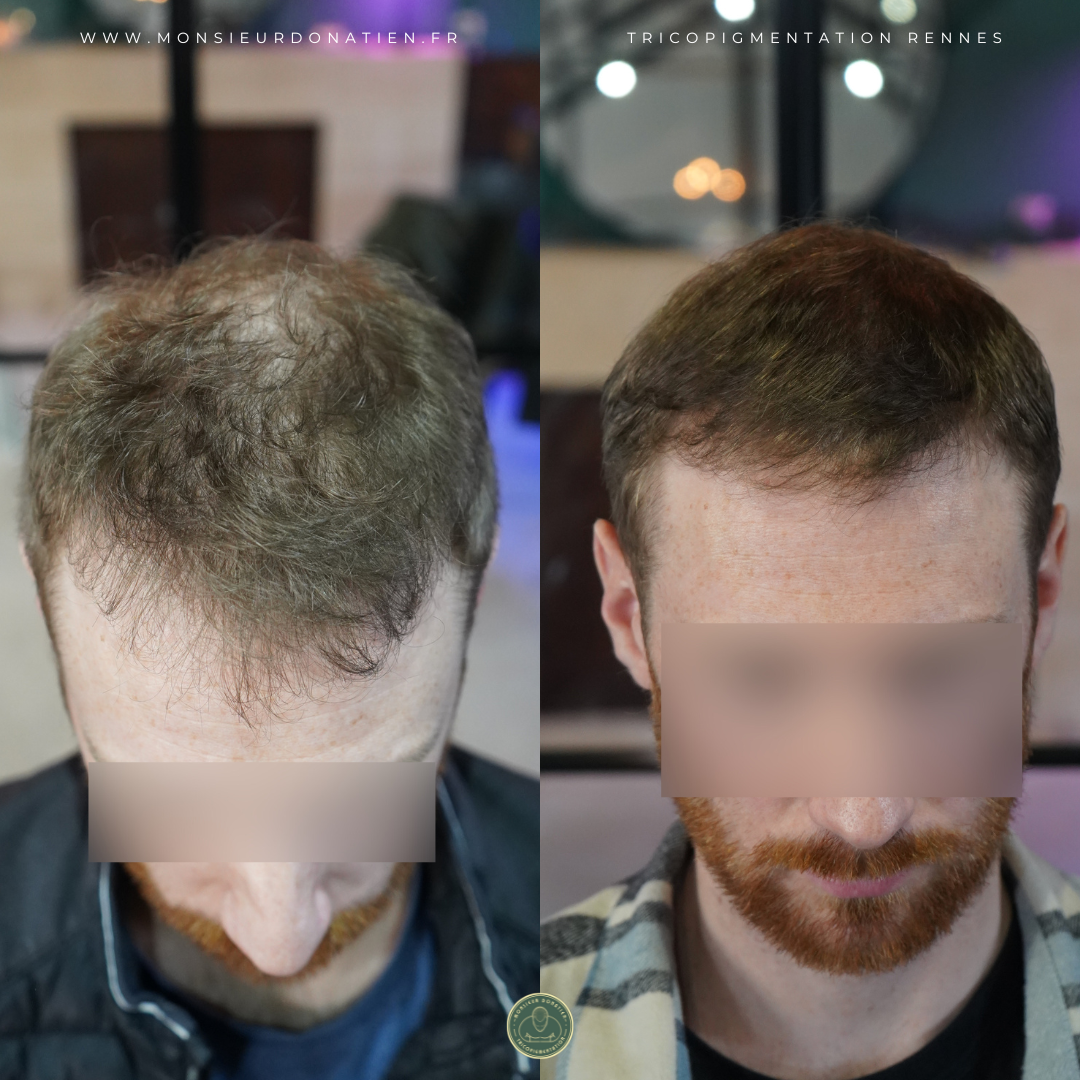 Tricopigmentation effet densité à Rennes - Monsieur Donatien