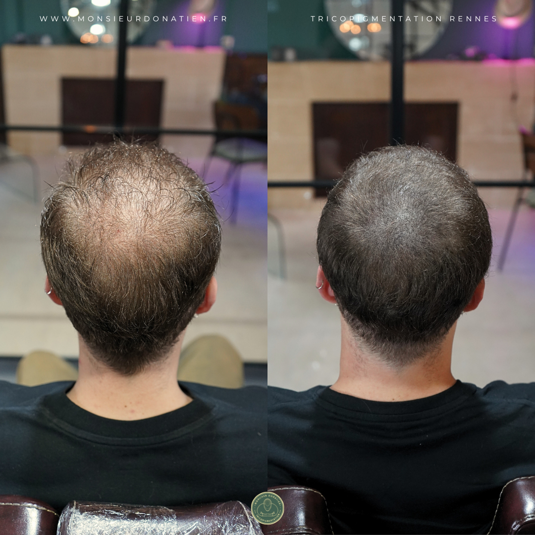 Tricopigmentation effet densité à Rennes - Monsieur Donatien