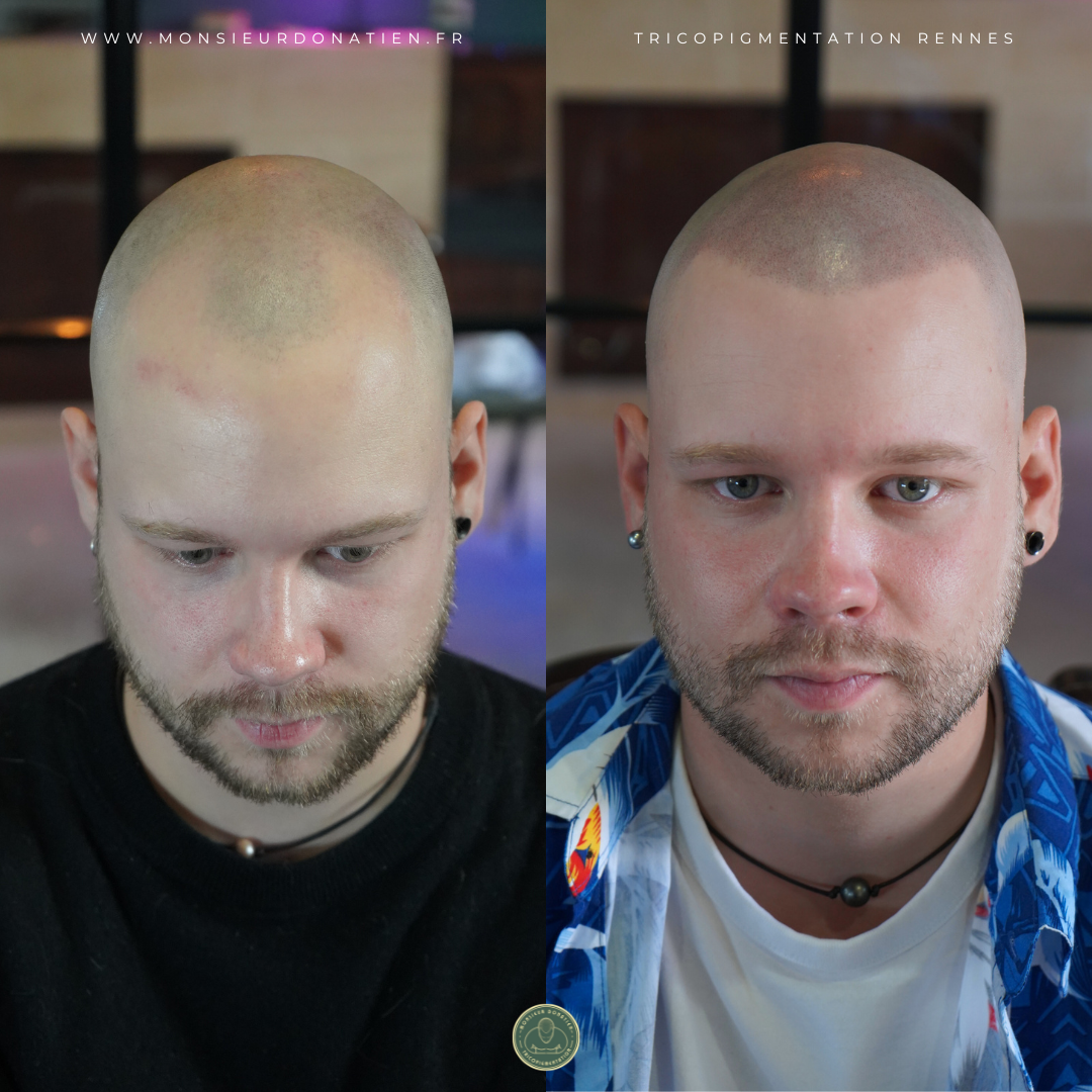 Avant / Après tricopigmentation sur cuir chevelu - Effet rasé - Monsieur Donatien Rennes.