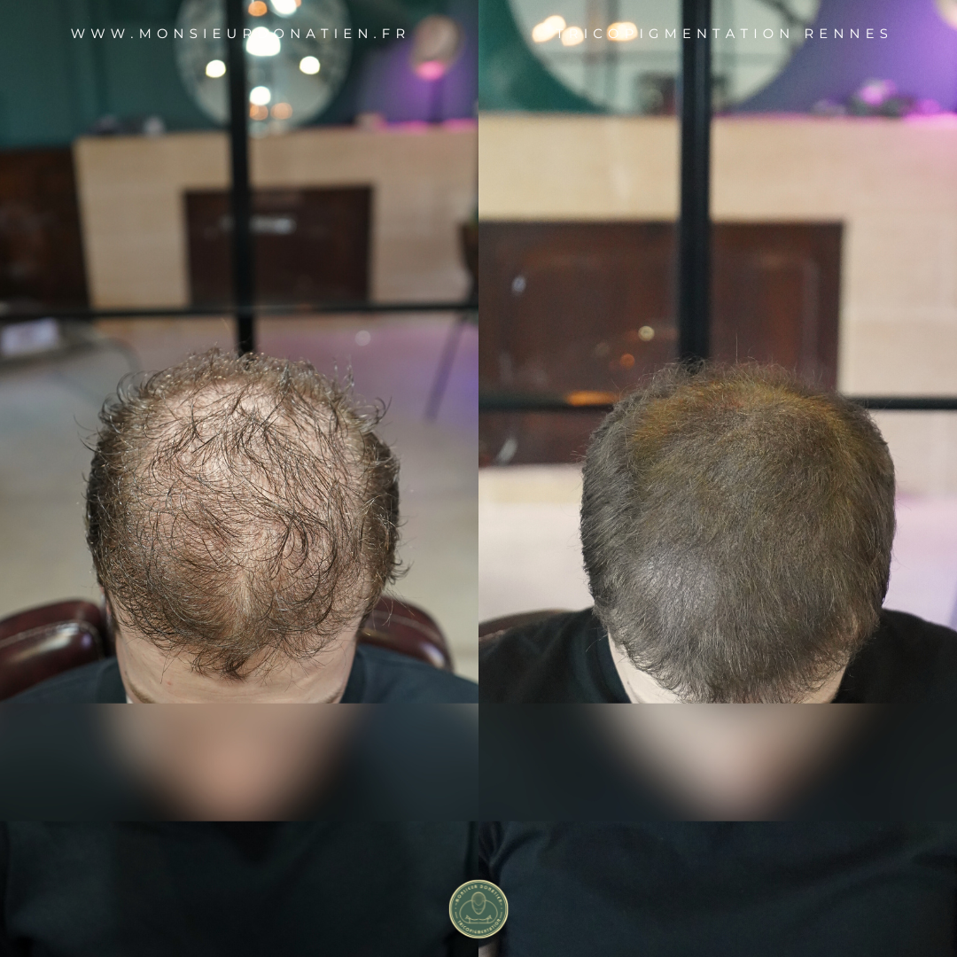 Tricopigmentation effet densité à Rennes - Monsieur Donatien