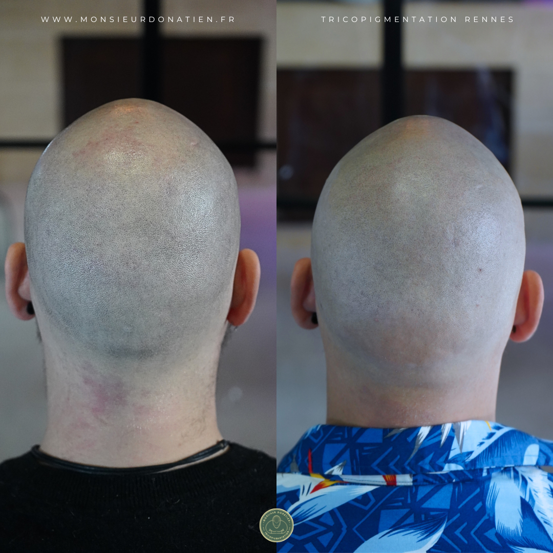 Avant / Après tricopigmentation sur cuir chevelu - Effet rasé - Monsieur Donatien Rennes.