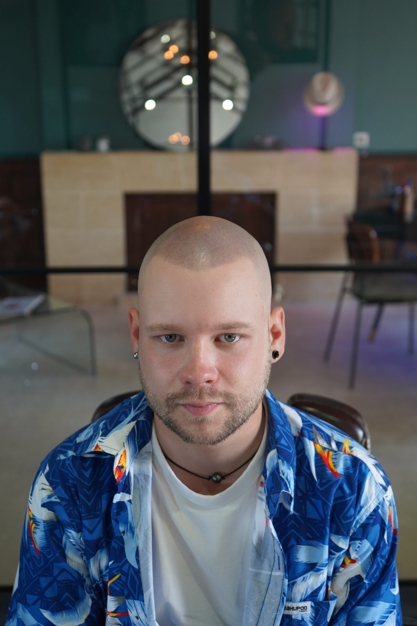 Avant / Après tricopigmentation sur cuir chevelu - Effet rasé - Monsieur Donatien Rennes.