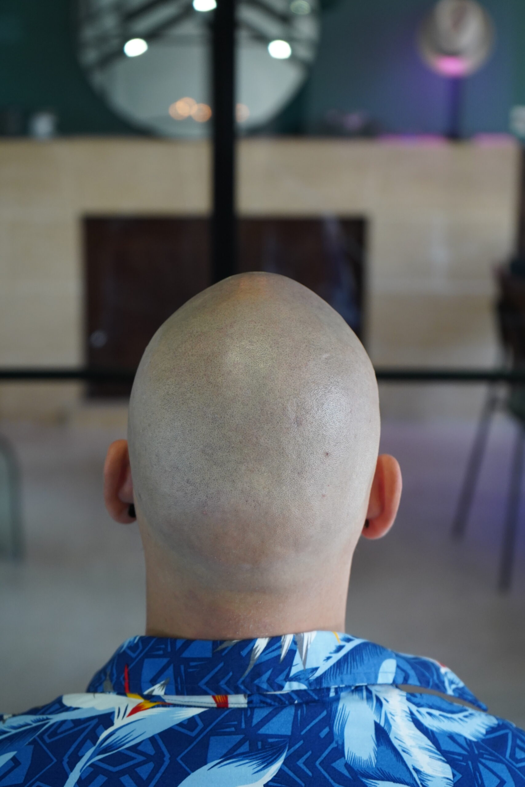 Avant / Après tricopigmentation sur cuir chevelu - Effet rasé - Monsieur Donatien Rennes.