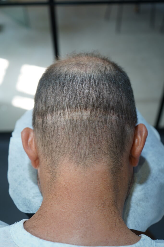 Cicatrice FUT suite greffe de cheveux 