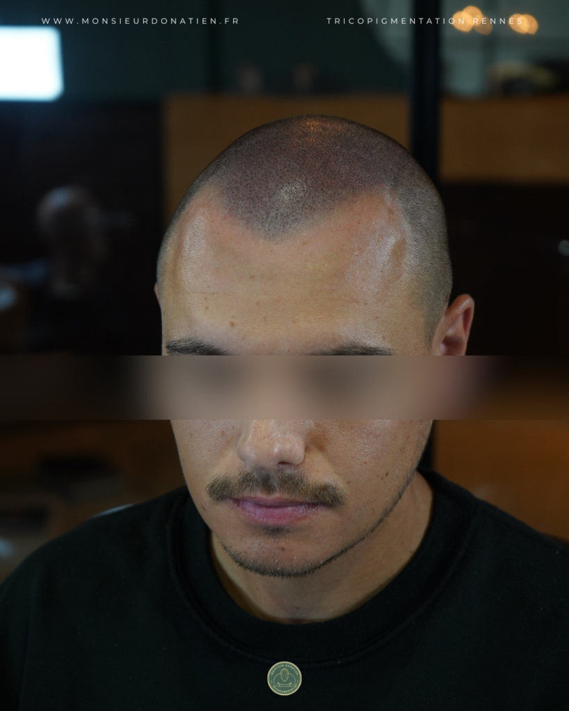 Micropigmentation du cuir chevelu après une greffe (homme de face)