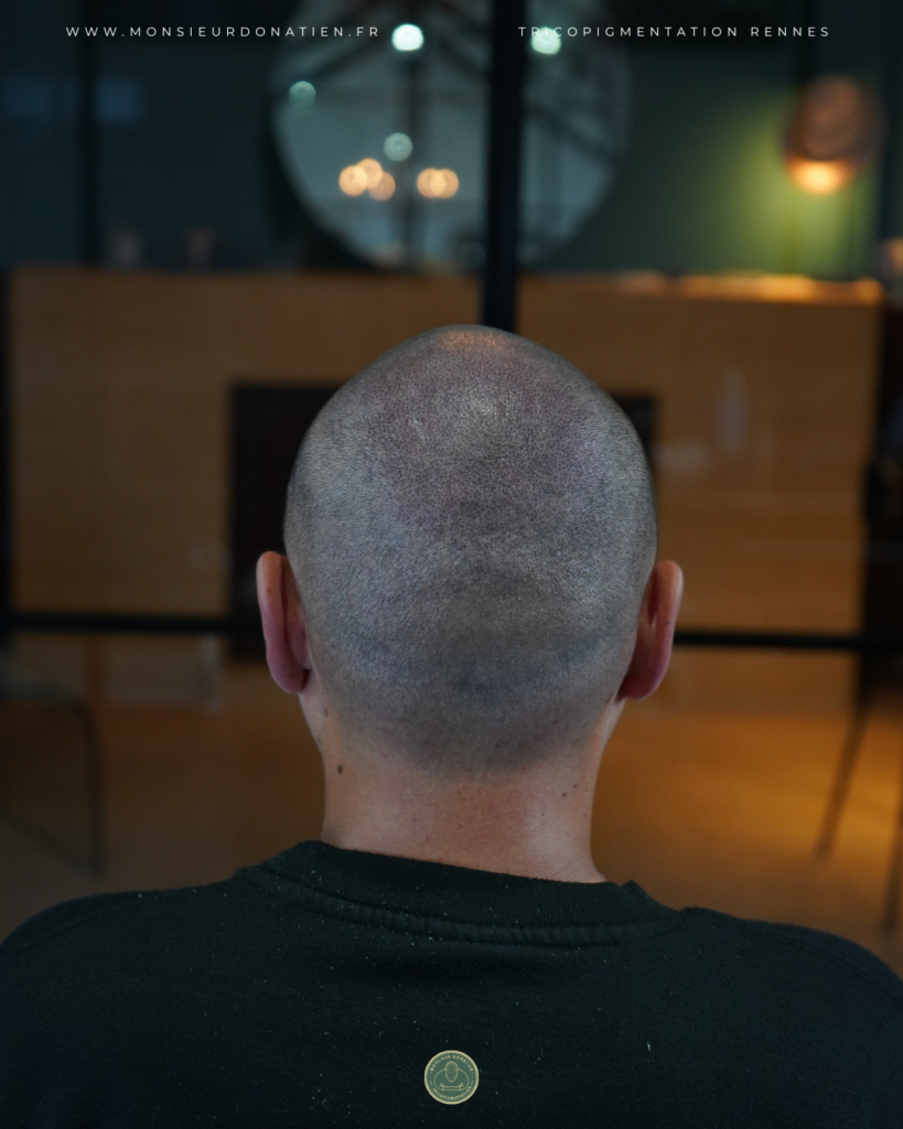 Micropigmentation du cuir chevelu après une greffe (homme de dos)