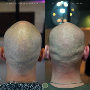 micropigmentation effet rasé avant après