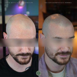 Tricopigmentation effet rasé