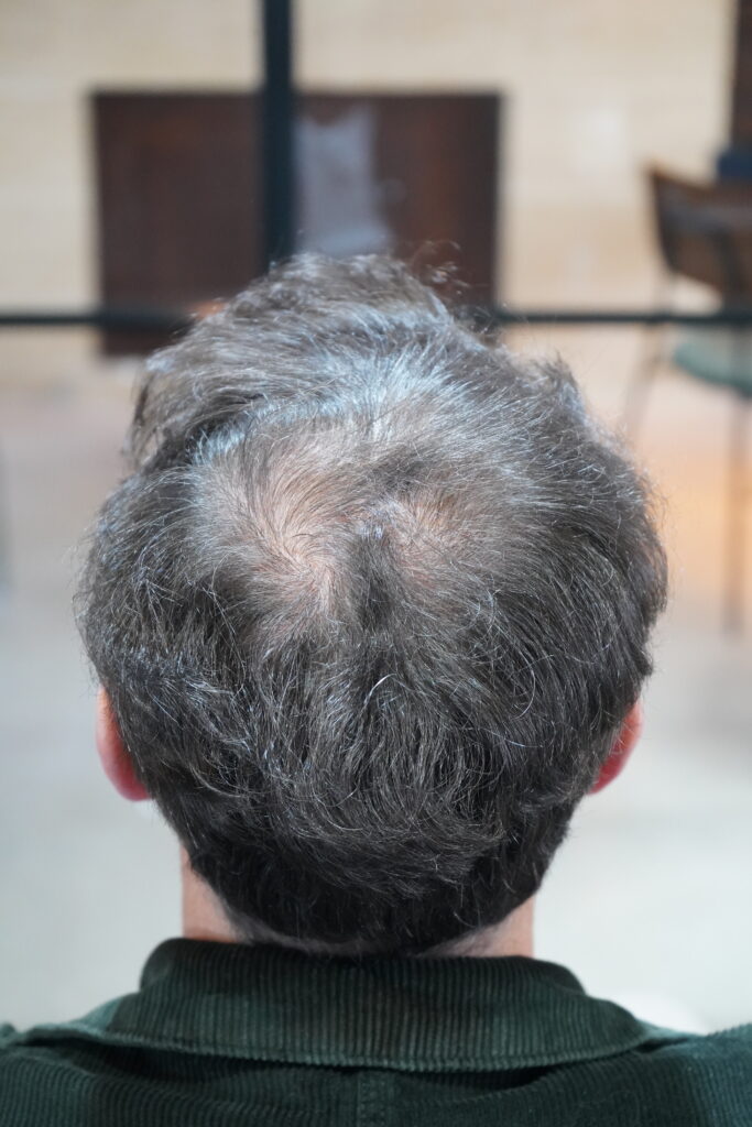 Chevelure avec manque de densité de dos 