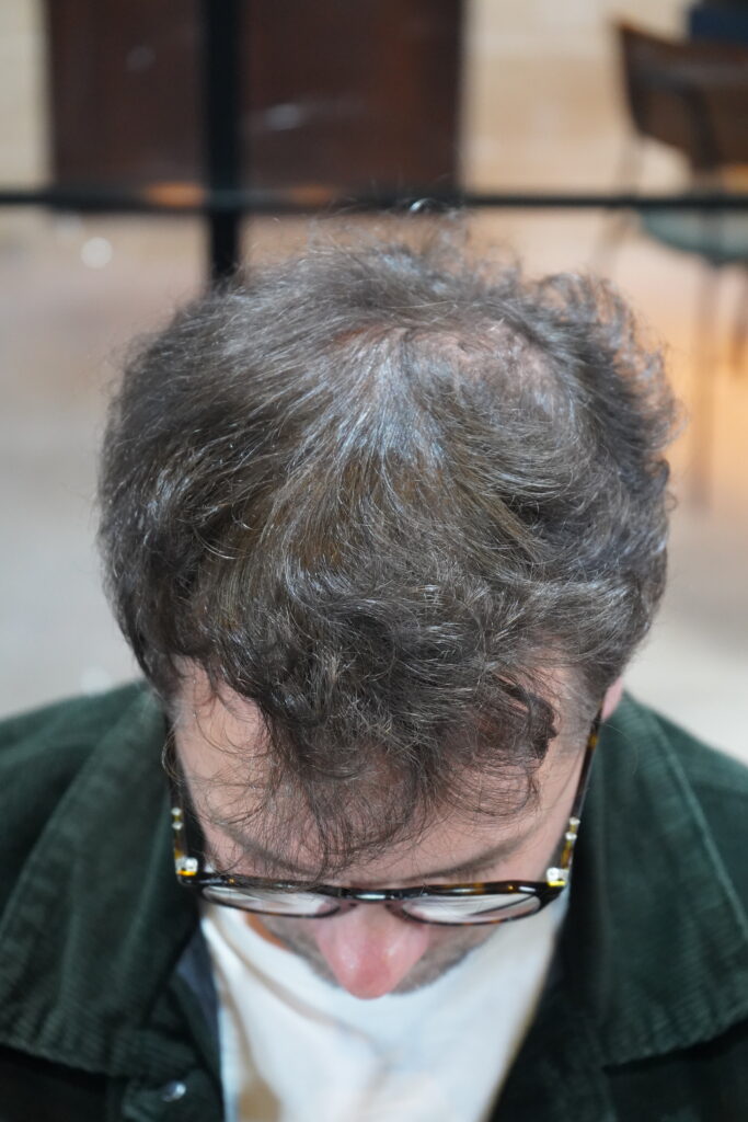 Chevelure avec manque de densité face avant 