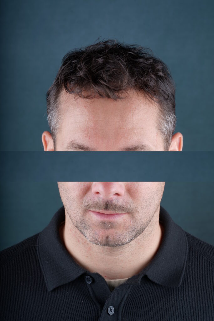 Résultat de la micropigmentation effet densité - photo de face 