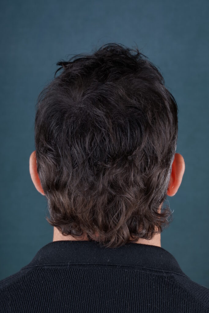 Résultat de la micropigmentation effet densité - photo de dos