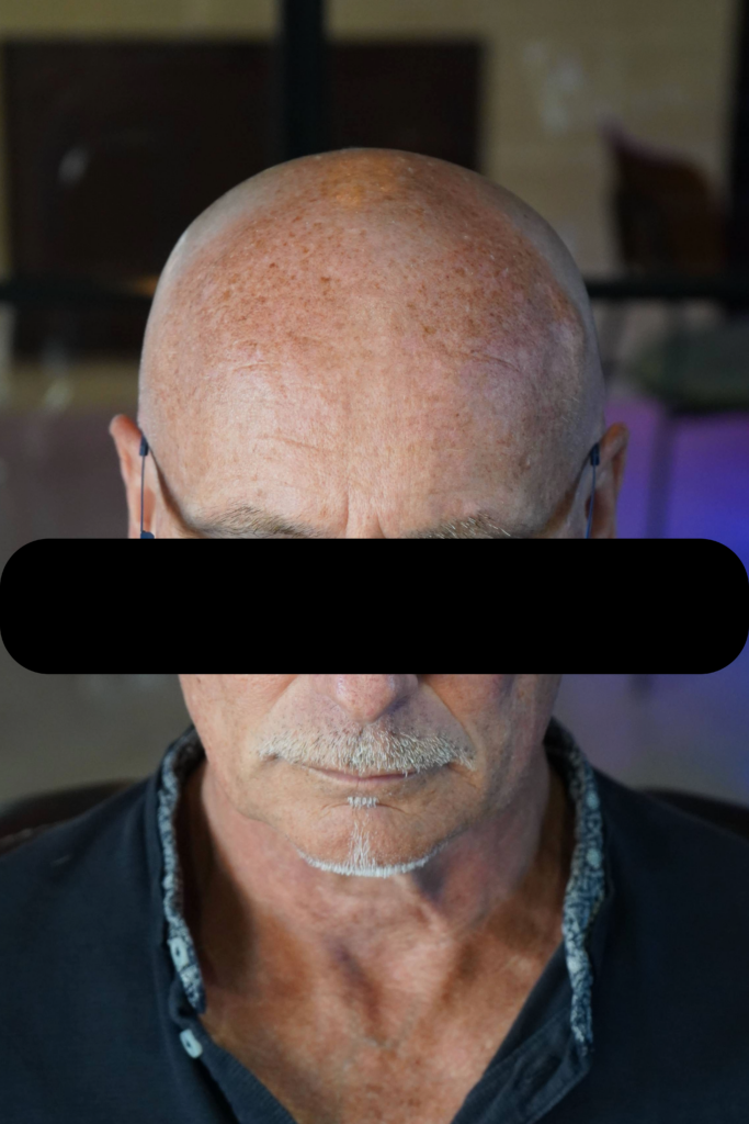 Photo de face : avant - redessin de la ligne frontale et effet rasé équilibré